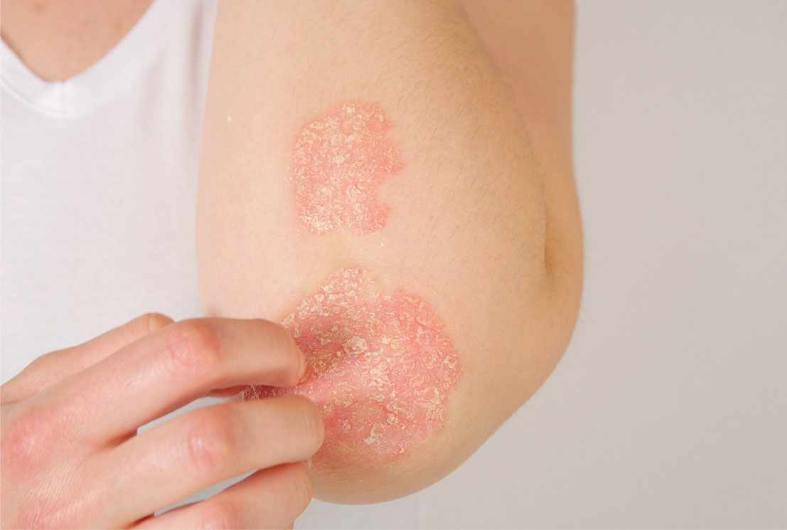 How Common is Psoriasis?
